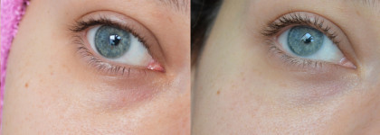 Так ли эффективны микроигольные патчи Blom?