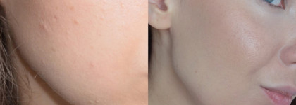 Как уход с кислотами навсегда избавил меня от комедонов?