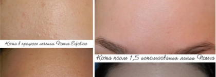 Как уход с кислотами навсегда избавил меня от комедонов?