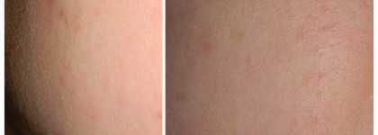 Как уход с кислотами навсегда избавил меня от комедонов?