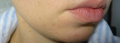 Массаж касторовым маслом против чёрных точек! Миф или реальность?