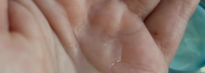 Что ты сделала? Сыворотка Bielenda Dr Medica ACNE Dermatological anti-acne SERUM