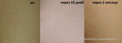 Lierac Phytostil в борьбе с растяжками