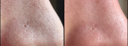 Ciracle Pore Control Blackhead Off Sheet или боремся с черными точками в домашних условиях