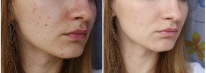 Мой фаворит тонального средства на теплое временя года CC крем «Абсолютное совершенство» Lumene CC Color Correcting Cream With Arctic Lingonberry 6 in 1 SPF 20. Оттенок Medium