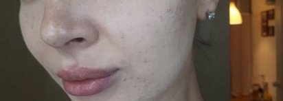 Всем страдающим посвящается... Что мне действительно помогло побороть акне