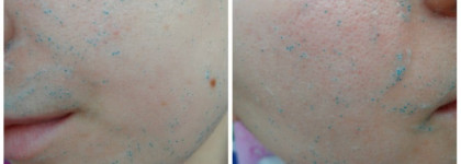 Парочка от Noreva Exfoliac. Борцы с несовершенствами кожи, которые не справились