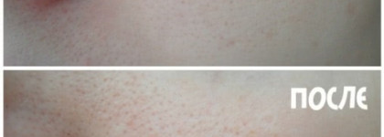 Парочка от Noreva Exfoliac. Борцы с несовершенствами кожи, которые не справились