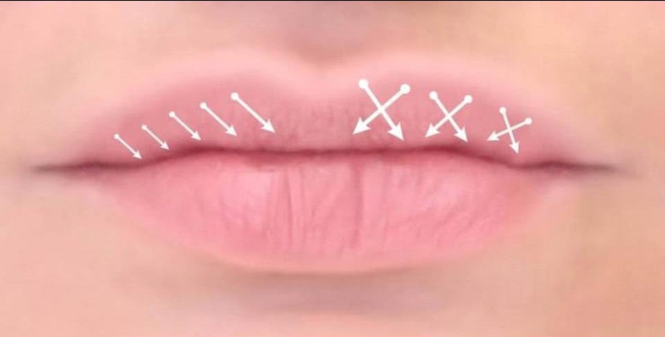 Увеличение губ: ответы врача на популярные вопросы