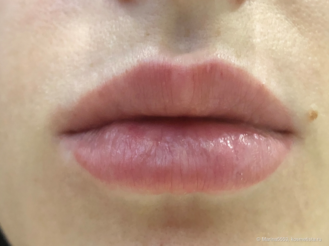 Почему формируются «гиалуроновые усы»?