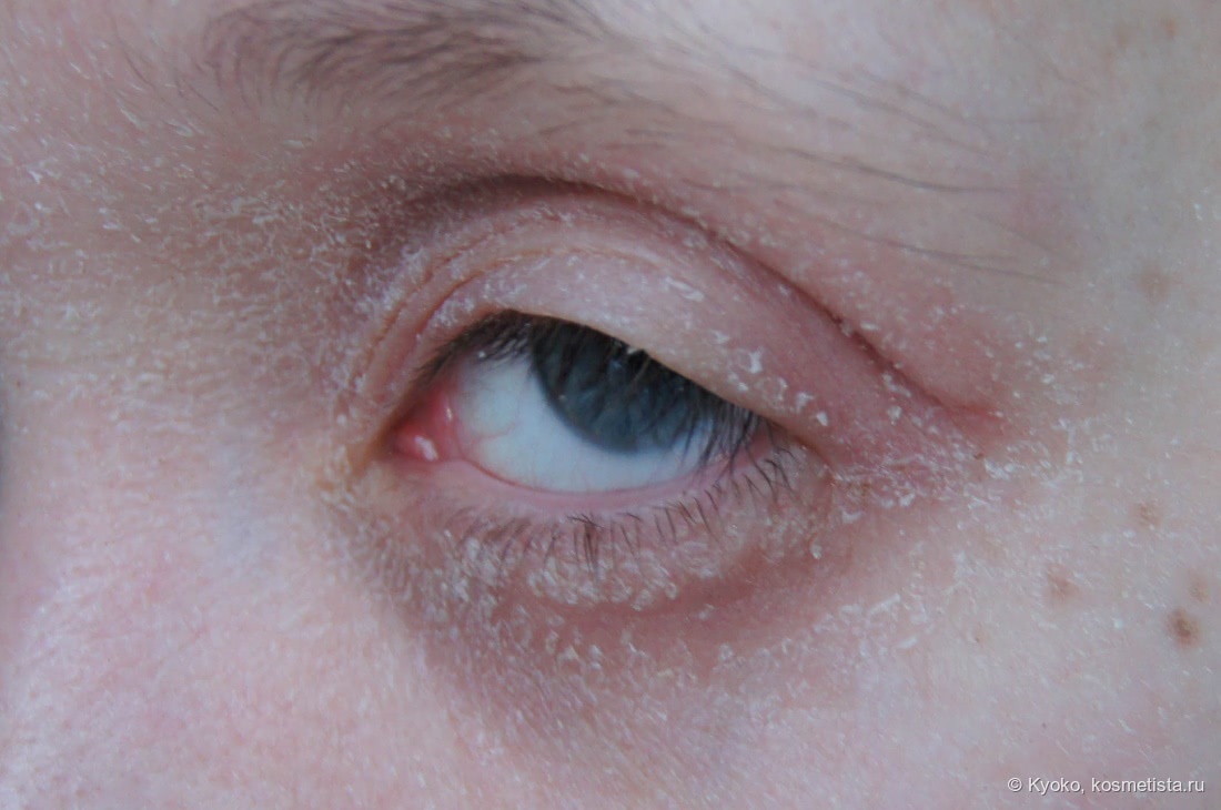 Помогут ли глазные капли или мазь от аллергии? Что делать, если чешутся глаза? - Всё о зрении.