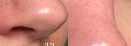 GlamGlow Clearing Supermud Treatment & Youthmud Glow Stimulating Treatment Mask