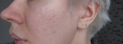 Тоник-пилинг на основе фруктовых кислот Hell pore AHA fruit toner, Elizavecca