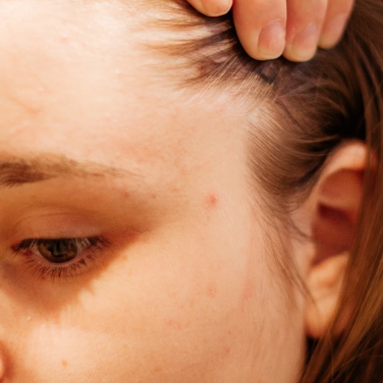 Я оду спою чудесной точечной пудре Skin Watchers от прыщей