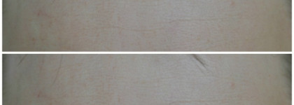 Атравматическая чистка лица с Holy Land в домашних условиях