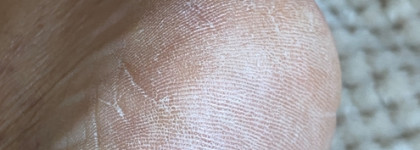 Незаменимый помощник для педикюра проблемных ног - Keratocontrol intensive от Sagitta Professional