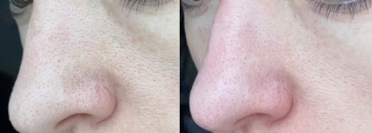 Kate Somerville ExfoliKate Intensive Exfoliating Treatment