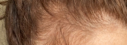 Мой помощник в возвращении волос после COVID - Сыворотка – активатор роста волос с капиксилом «Крапива» от Kleona