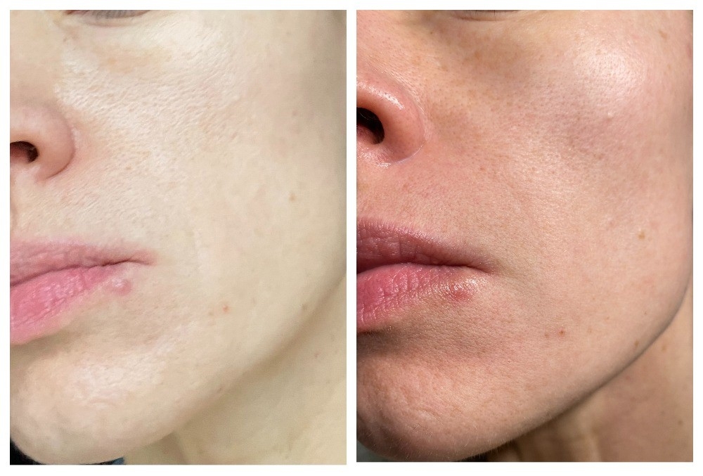 Слева - до, справа - после (на всякий случай 8-)) разовое использование на 25 минут