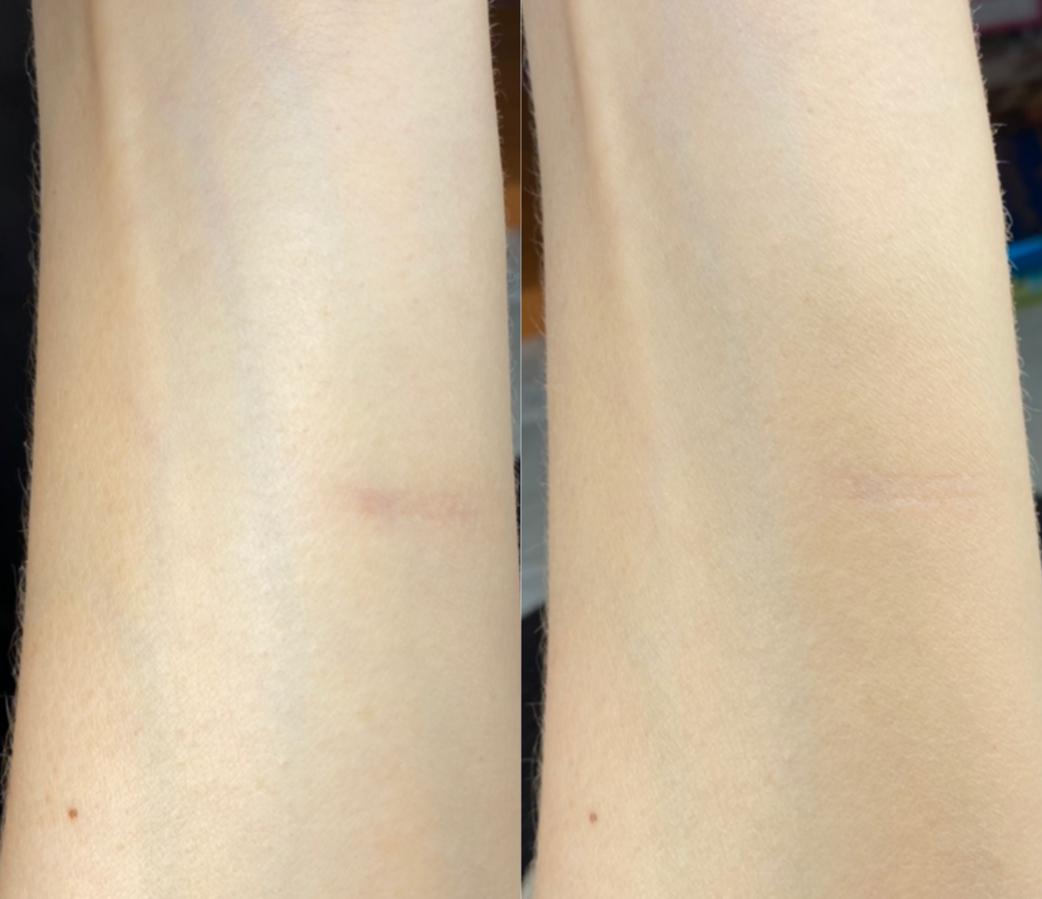 Слева - до нанесения пудры, справа - щедр онанесенная пудра.