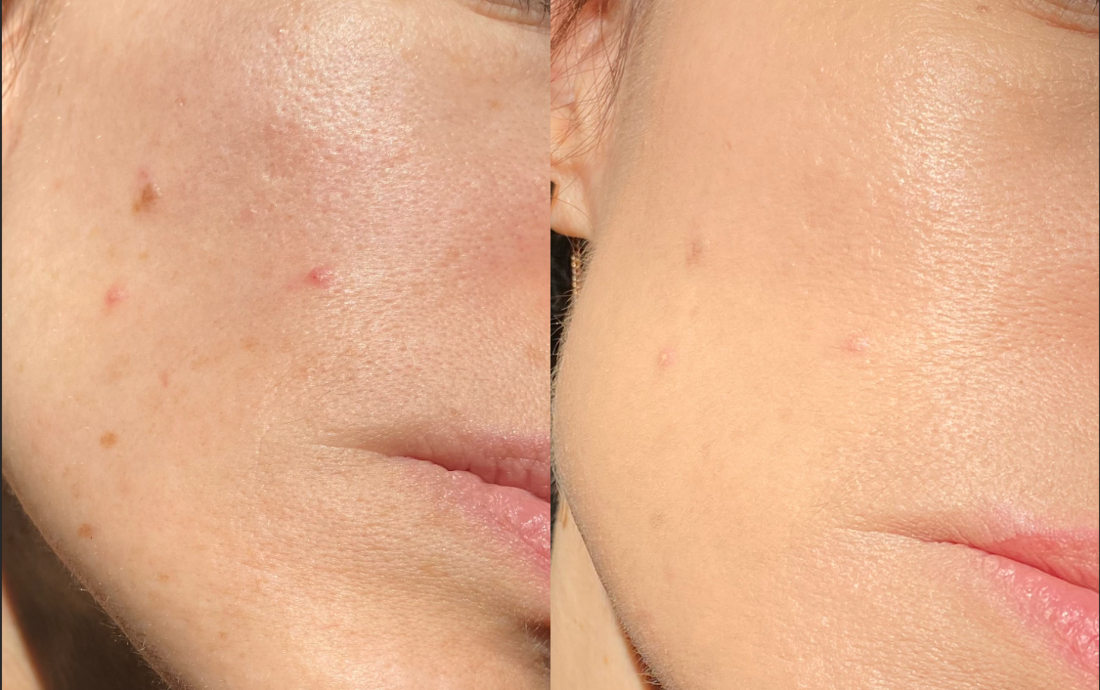 Увлажняющий ВВ-крем с гиалуроновой кислотой Hyaluronic Ultra Moisture BB Cream SPF 28/PA++ от Limoni свотчи. Слева - "До" голая воспаленная кожа, справа - "После" с этим ВВ