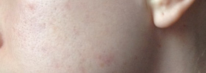 Выводим постакне за 10 дней - с Gigi Solar Energy Mud Mask For Oily Skin