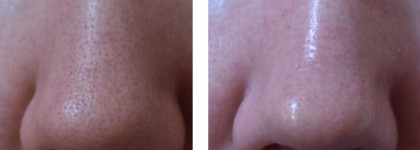 Мой верный товарищ на долгие годы: скраб Clinique Exfoliating Scrub Gommage Tonique (фото до\после)