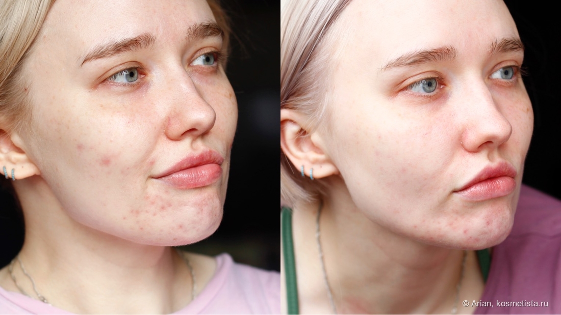 Состояние кожи лица после 2 месяцев использования сывороток (день — гиалуроновая, ночь — ниацинамид + кислоты)