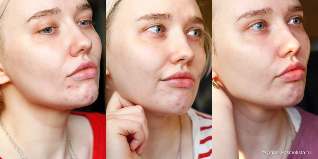 Состояние кожи до начала использования сыворотки - через две недели - через месяц применения (слева направо)