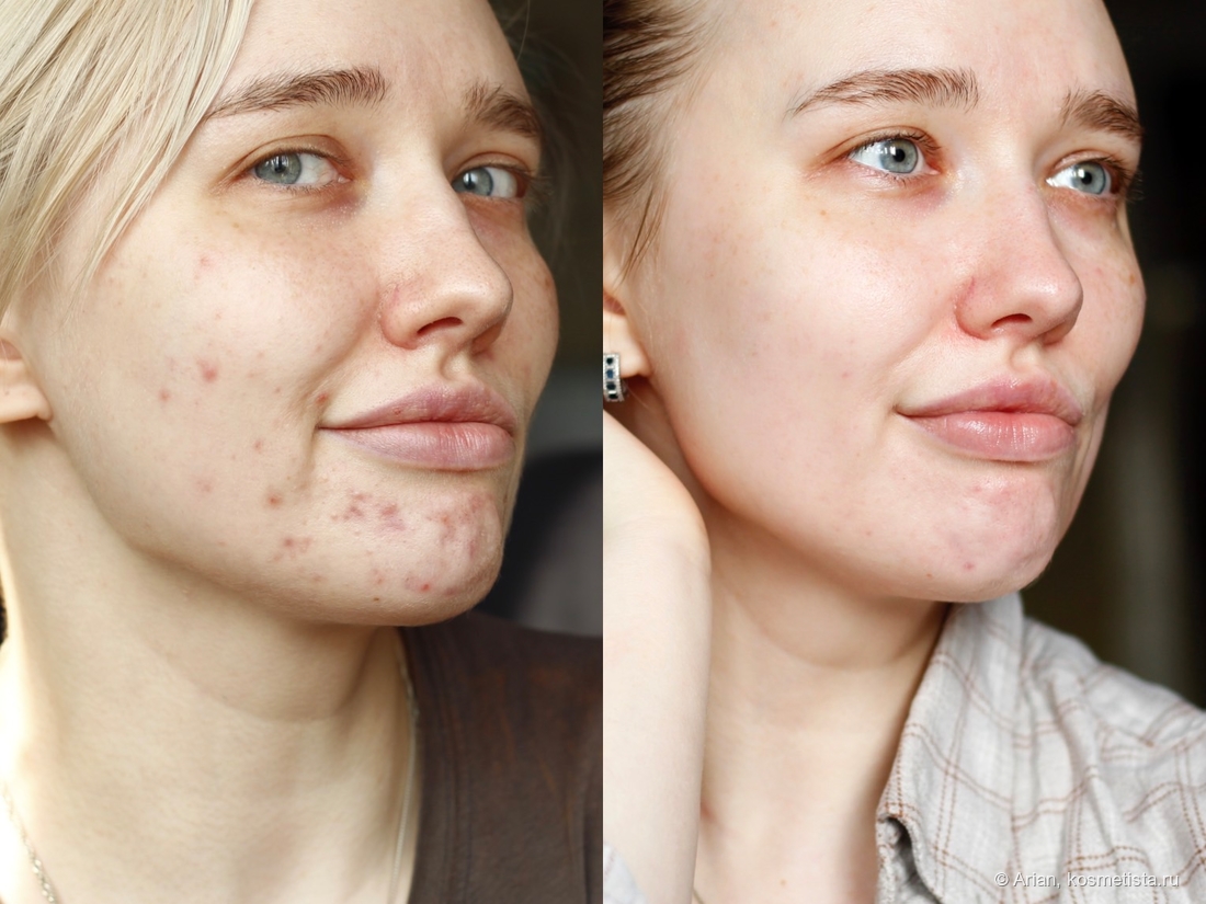 Состояние кожи чуть больше года назад, когда меня поразила дерматитная жуть, и сейчас (справа). Кожа всё ещё не в идеальном состоянии, и вряд ли будет, но меня всё равно радует.