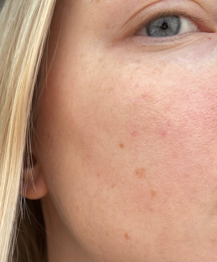 Кожа после использования Sensitive в качестве маски и Concentre как базового ухода