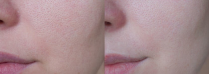 Маски и сыворотка для дополнительного ухода за реактивной кожей с куперозом. Мои помощники в борьбе с краснотой