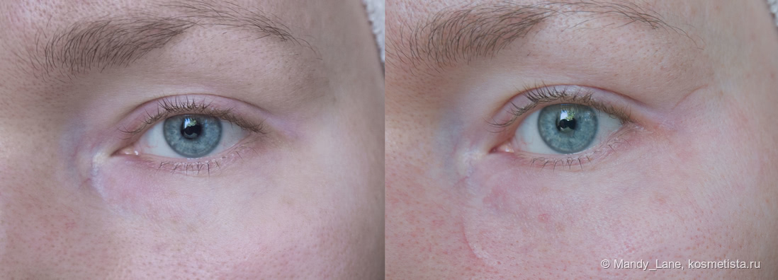 До/ после применения BLOM Microneedle Eye Patches Moisturizing And Rejuvenating