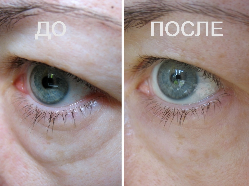 Что такое сангапури для глаз в косметологии. Refaltis Eyes фото до и после. Рефалтис айс для глаз. Refaltis Eyes. 5) Photozyme IQUAD total Eye Care.