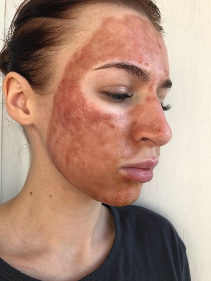 отзывы о лазерной шлифовке кожи лица