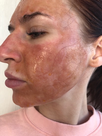 Лазерная терапия для кожи лица отзывы