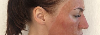 Лазерная шлифовка лица. Как это было: дневник реабилитации+ фото