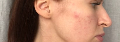 Лазерная шлифовка лица. Как это было: дневник реабилитации+ фото