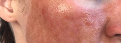 Лазерная шлифовка лица. Как это было: дневник реабилитации+ фото