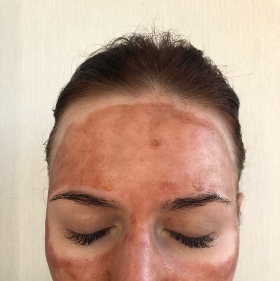 Лазерная терапия для кожи лица отзывы thumbnail