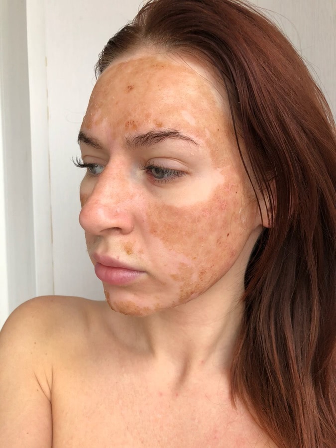 Восстановление кожи лица после шлифовки