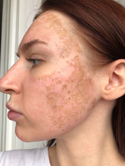 Лазерная терапия для кожи лица отзывы