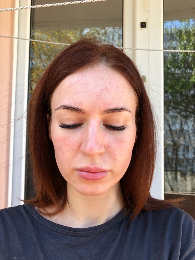 Лазерная коррекция кожи лица отзывы thumbnail