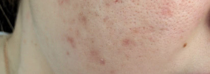 Корректирующий тональный флюид dermablend Vichy Dermablend Fluid Corrective Foundation SPF 35 #15