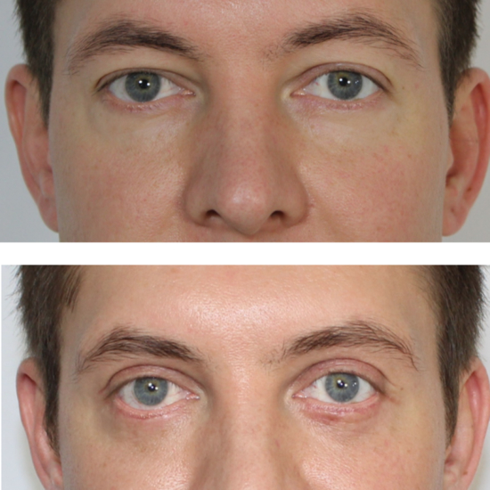Увеличение разреза глаз | Косметиста