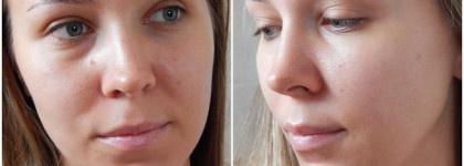 Ротация средств в уходе за жирной проблемной кожей в период холодов