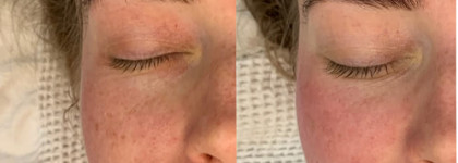 Молочный пилинг Skin Laboratory Lactic/70. Домашний салон красоты и результаты от курса пилингов