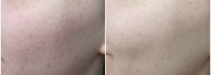 Тональный крем Lumene Matt control oil-free foundation в оттенке #00 был для меня маст хэвом, но после ребрендинга что-то пошло не так. Фото ДО и После