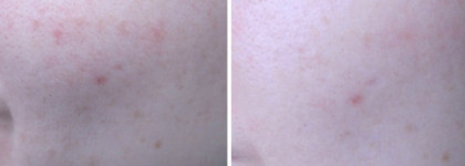 Чистая Линия крем-актив от прыщей  из серии Идеальная кожа. Цинк и чайное дерево в составе.  Фото До и После