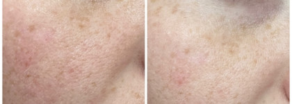 Очищение и лифтинг - маска GIGI Lotus Beauty Astringent Mask